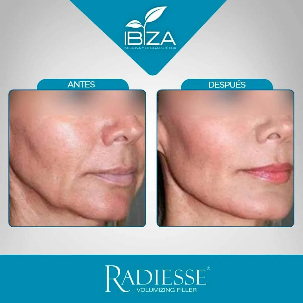 Radiesse antes y después efecto V facial