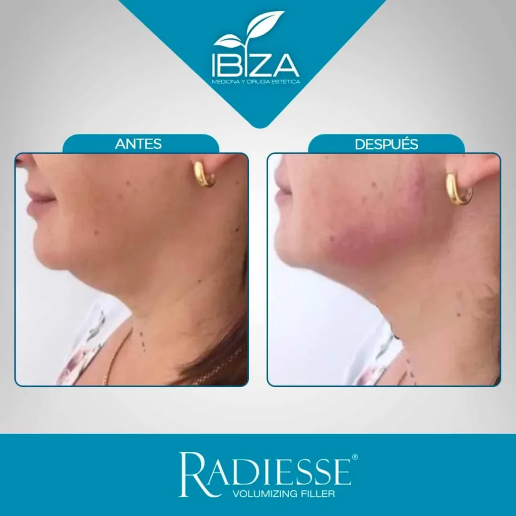 Radiesse antes y después marcación mandibular