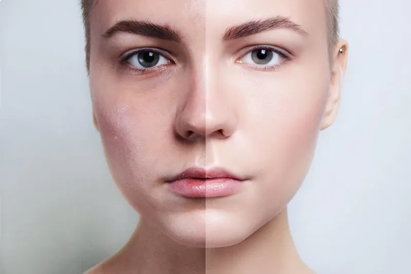 Comparación antes y después de resurfacing facial en rostro de mujer joven