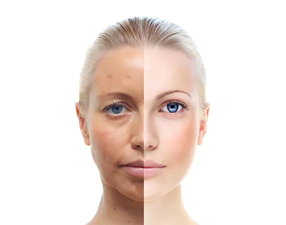 Comparación antes y después de resurfacing facial en mujer rubia con piel rejuvenecida