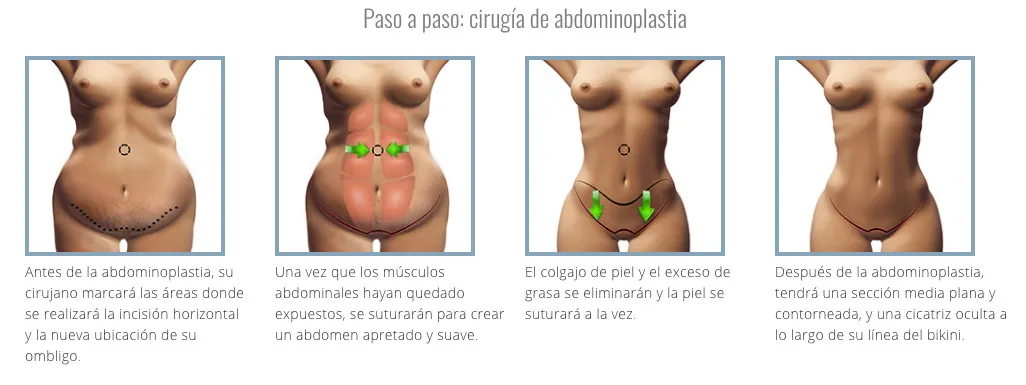 Pasos de la abdominoplastia · esquema del procedimiento