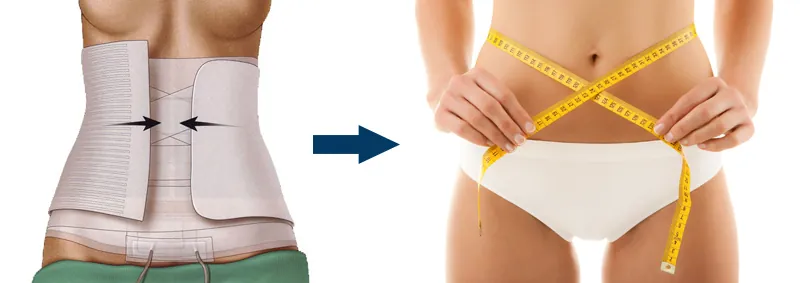 Recuperación tras la abdominoplastia