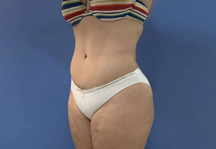 Abdominoplastia (resultado) — Clínica Ibiza Madrid