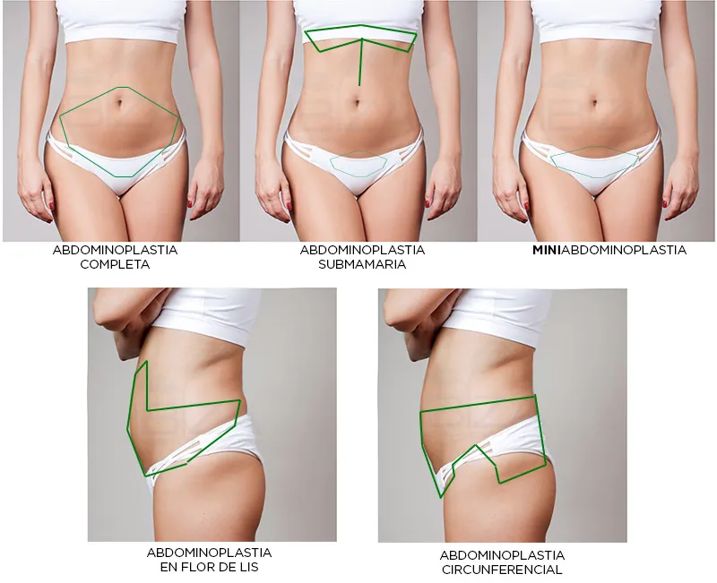Tipos de abdominoplastia
