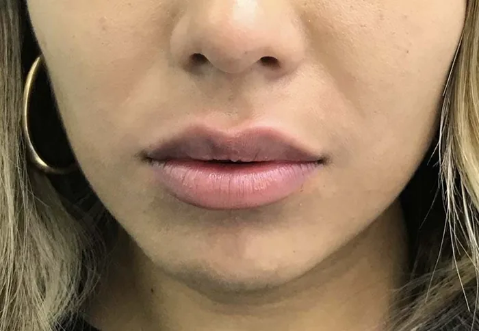 Aumento de labios con ácido hialurónico (resultado) — Clínica Ibiza Madrid
