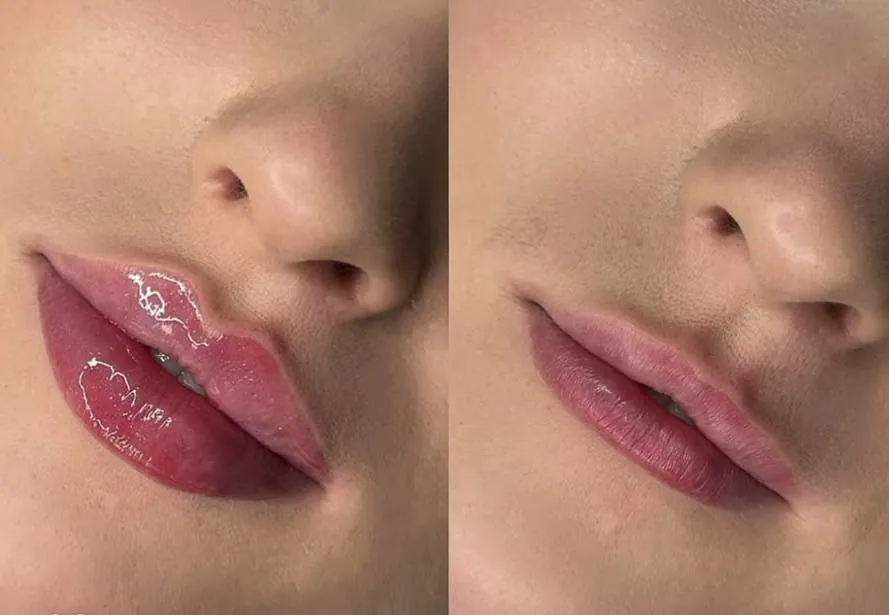 Aumento de labios con ácido hialurónico — caso 1