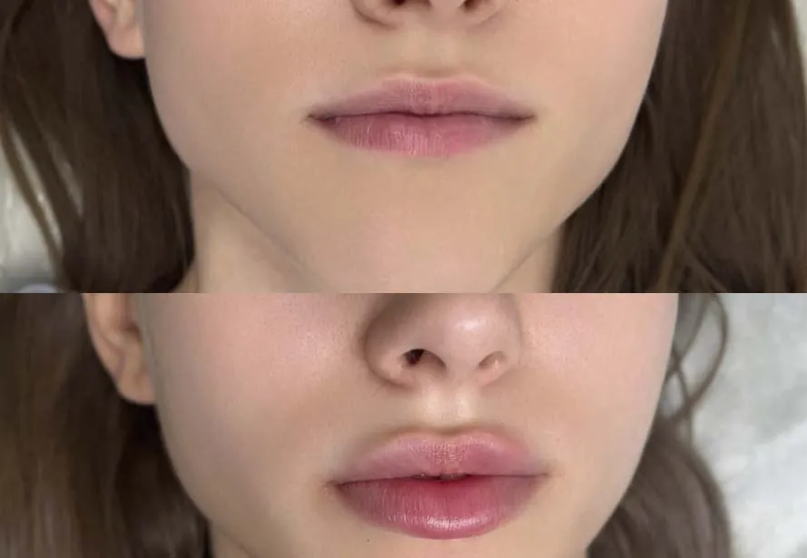 Aumento de labios con ácido hialurónico — caso 2