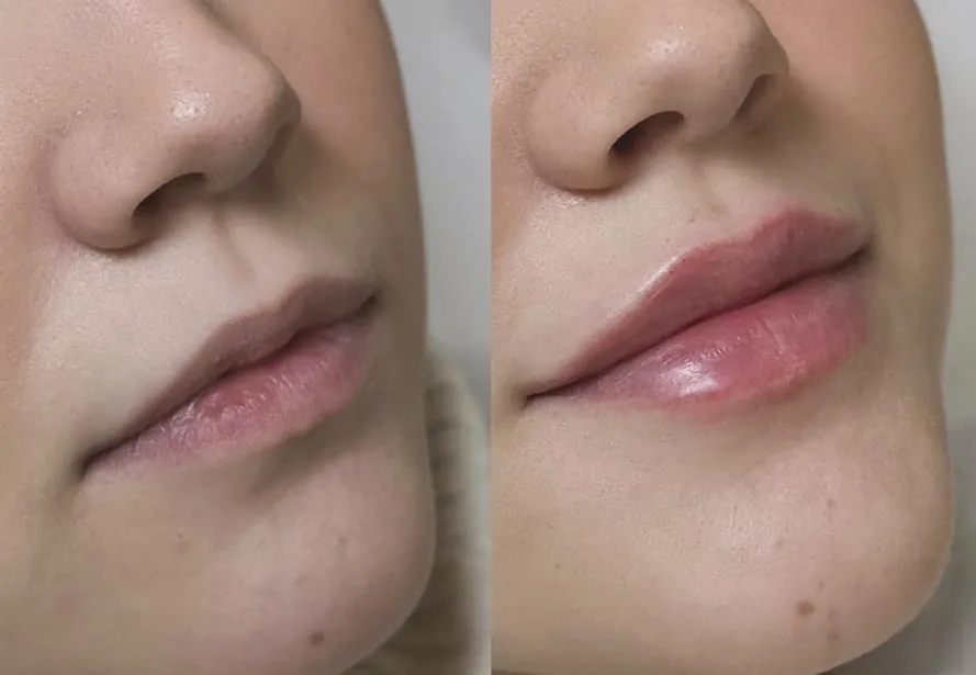 Aumento de labios con ácido hialurónico — caso 3