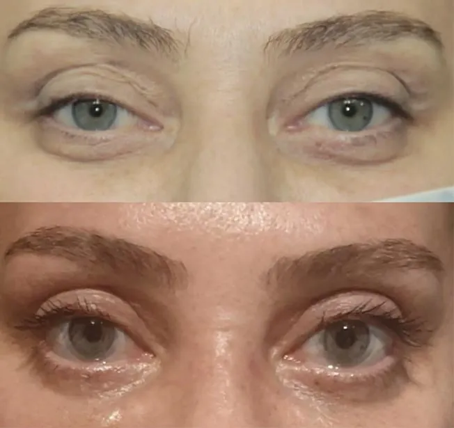 Blefaroplastia antes y después · caso 1