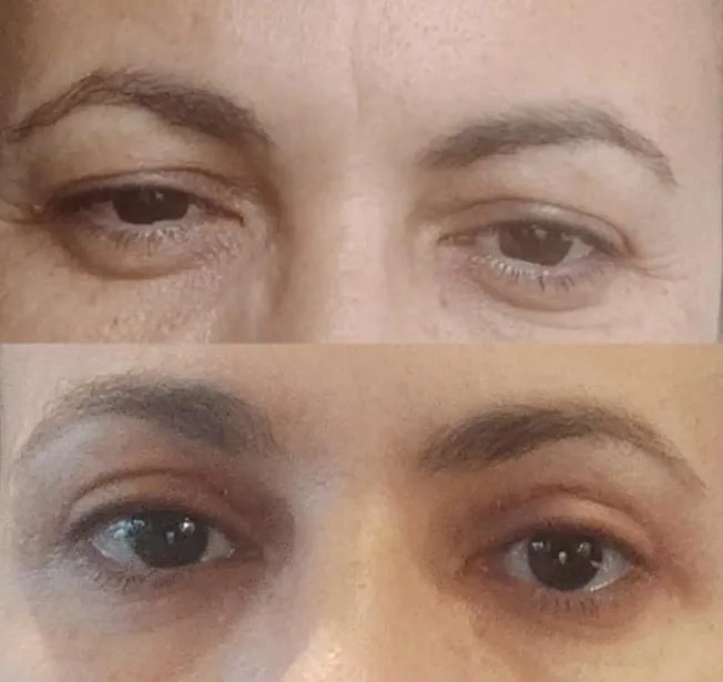 Blefaroplastia antes y después · caso 2