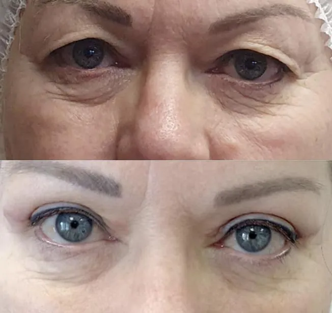 Blefaroplastia antes y después · caso 3