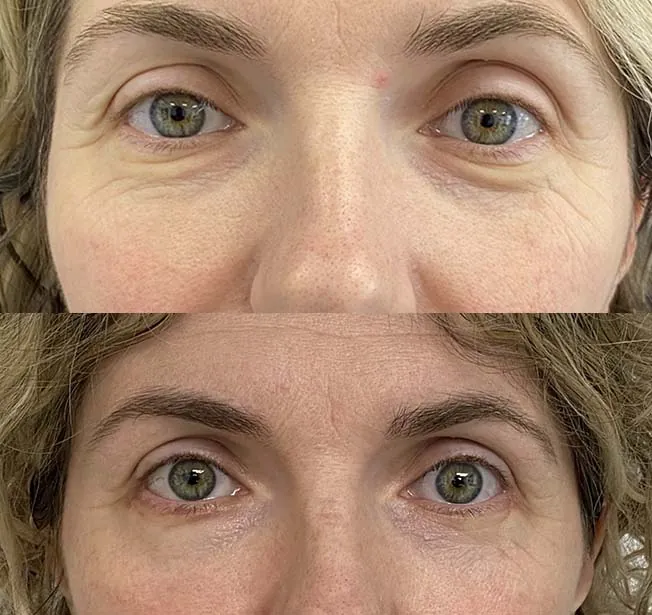 Blefaroplastia antes y después · caso 4