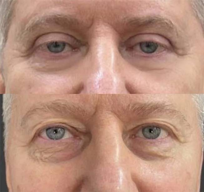 Blefaroplastia en hombres