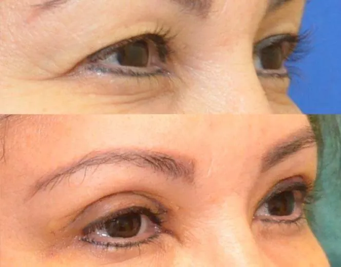 Blefaroplastia superior en Clínica Ibiza