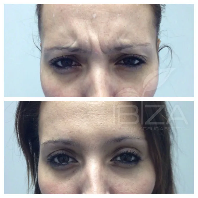 Bótox precio entrecejo - Clínica Ibiza Madrid