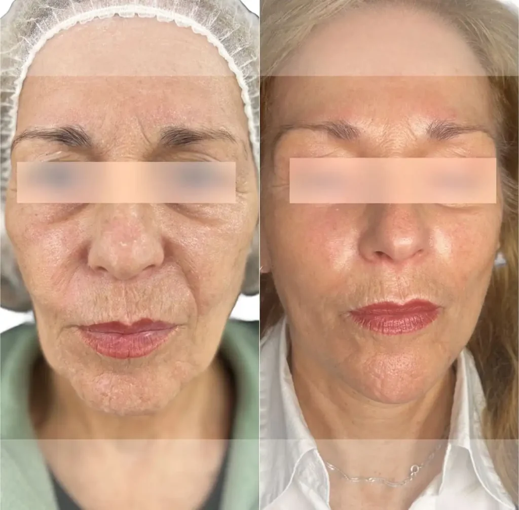 Flacidez facial antes y después del tratamiento, caso representativo
