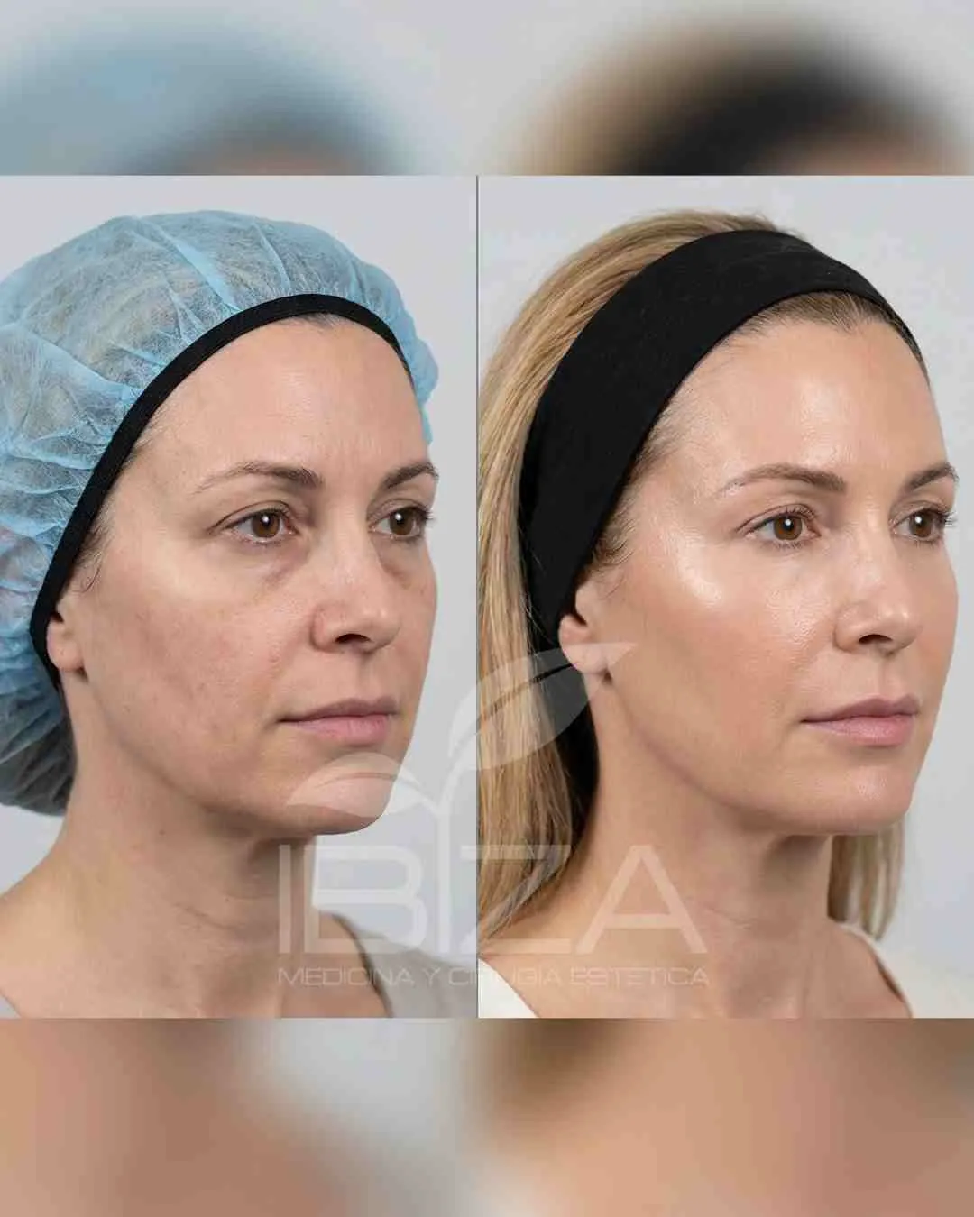 Full Face antes y después — caso real paso a paso