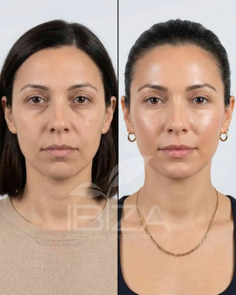 Full Face antes y después — mujer 30 años