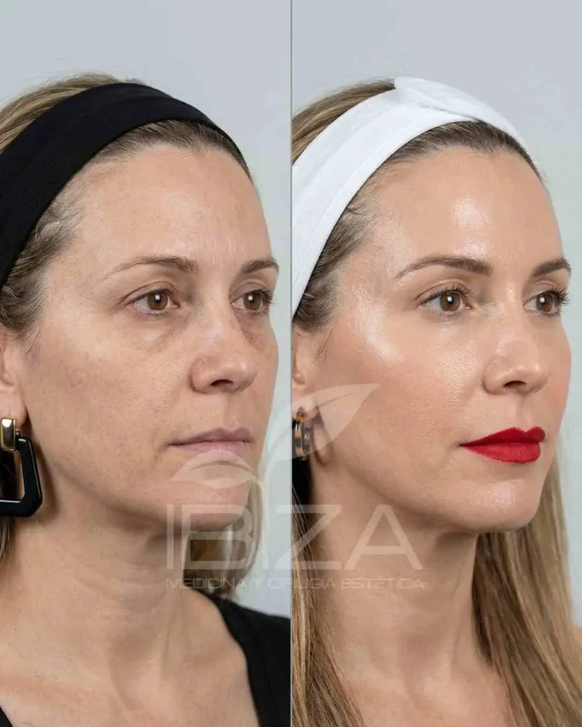 Full Face antes y después — mujer 50 años