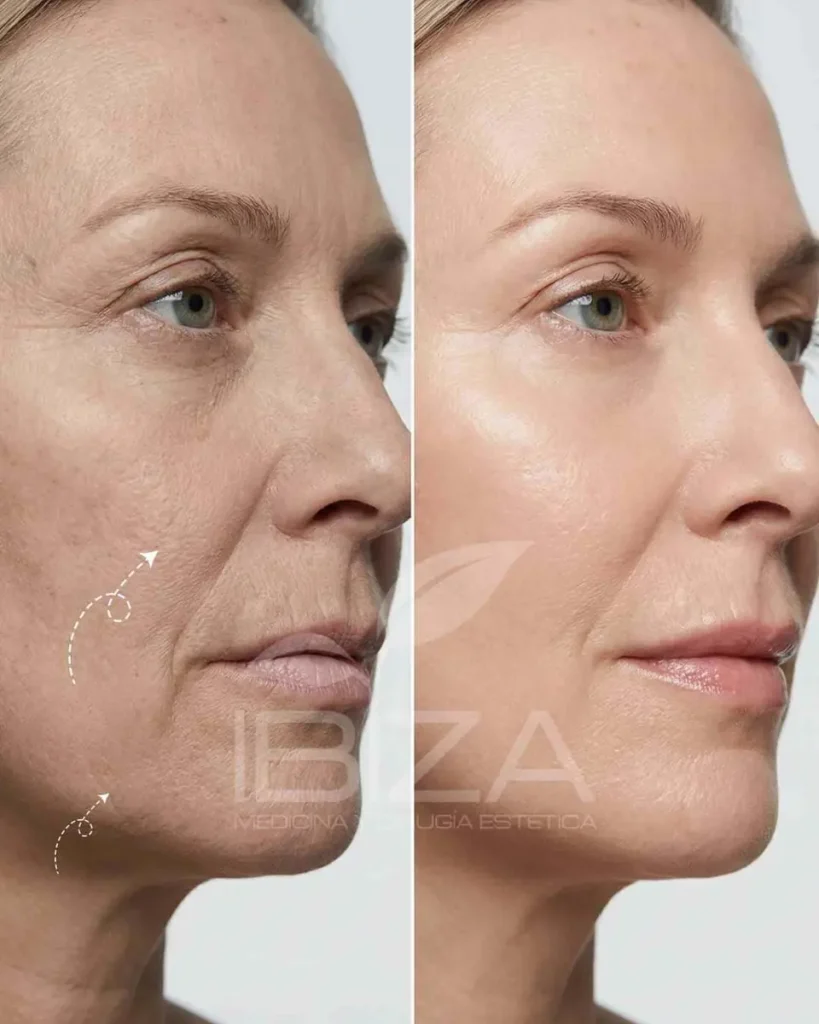 Hidratación facial antes y después, caso 1