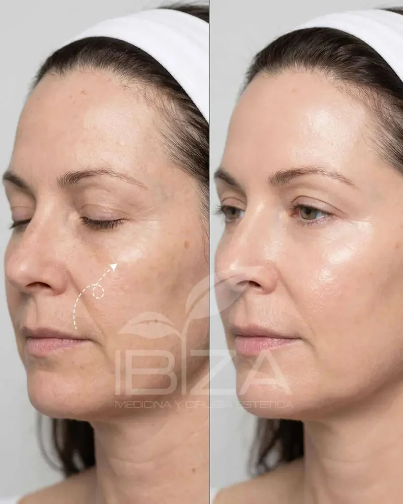Hidratación facial antes y después, caso 2