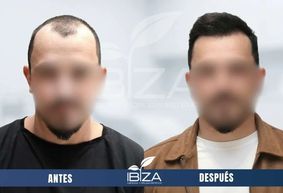 Implante capilar resultado antes/después en hombre de 35 años con 2950 UF, resultado a los 12 meses