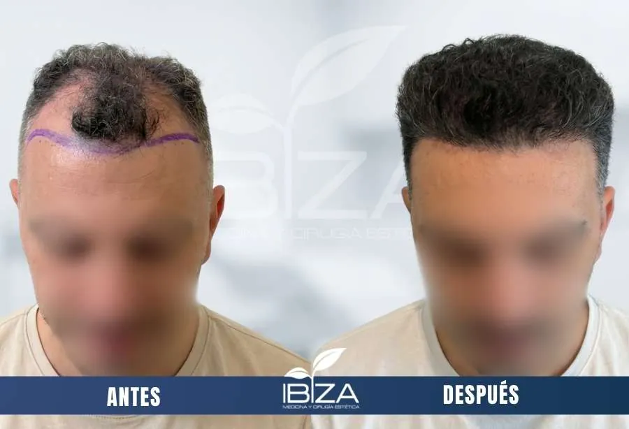 Implante capilar cambio antes y después en hombre de 36 años con 3750 UF, resultado a los 11 meses