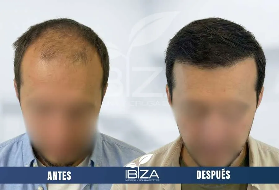Injerto capilar antes y después en hombre de 27 años con 2850 UF, resultado a los 14 meses