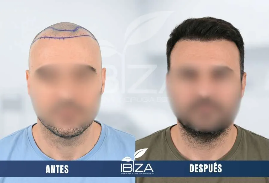 Injerto capilar evolución antes y después en hombre de 37 años con 3200 UF, resultado a los 13 meses