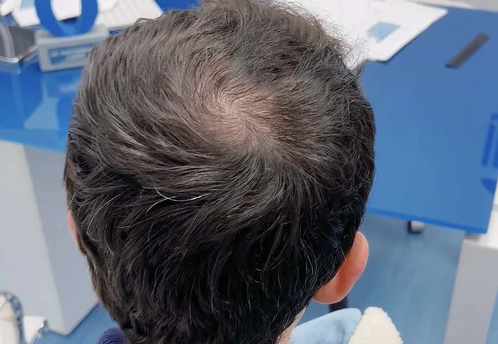 Injerto capilar FUE (resultado) — Clínica Ibiza Madrid
