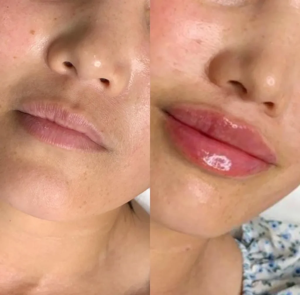 Labios rusos (Russian lips) con ácido hialurónico — caso 1