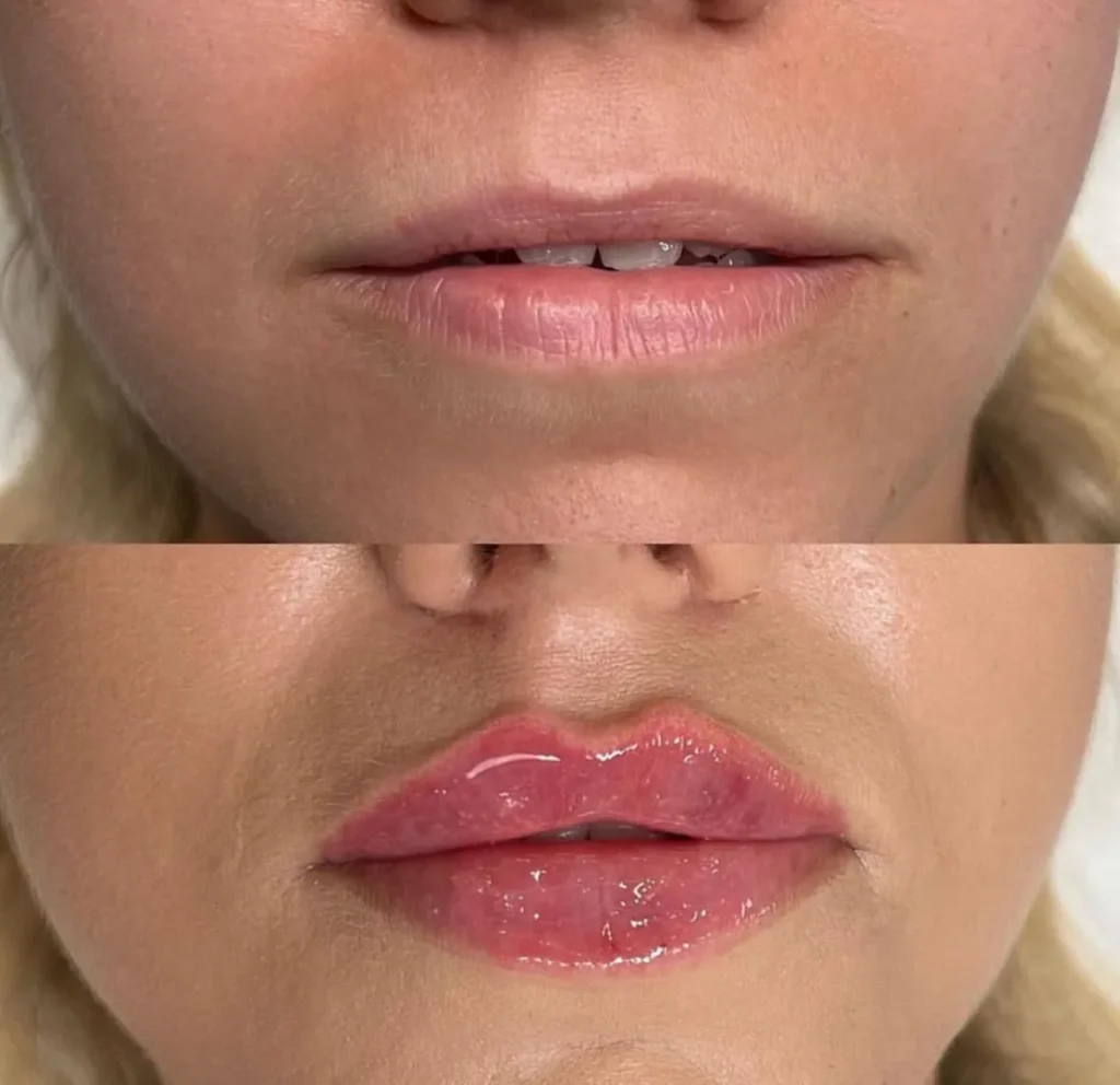 Labios rusos (Russian lips) con ácido hialurónico — caso 2
