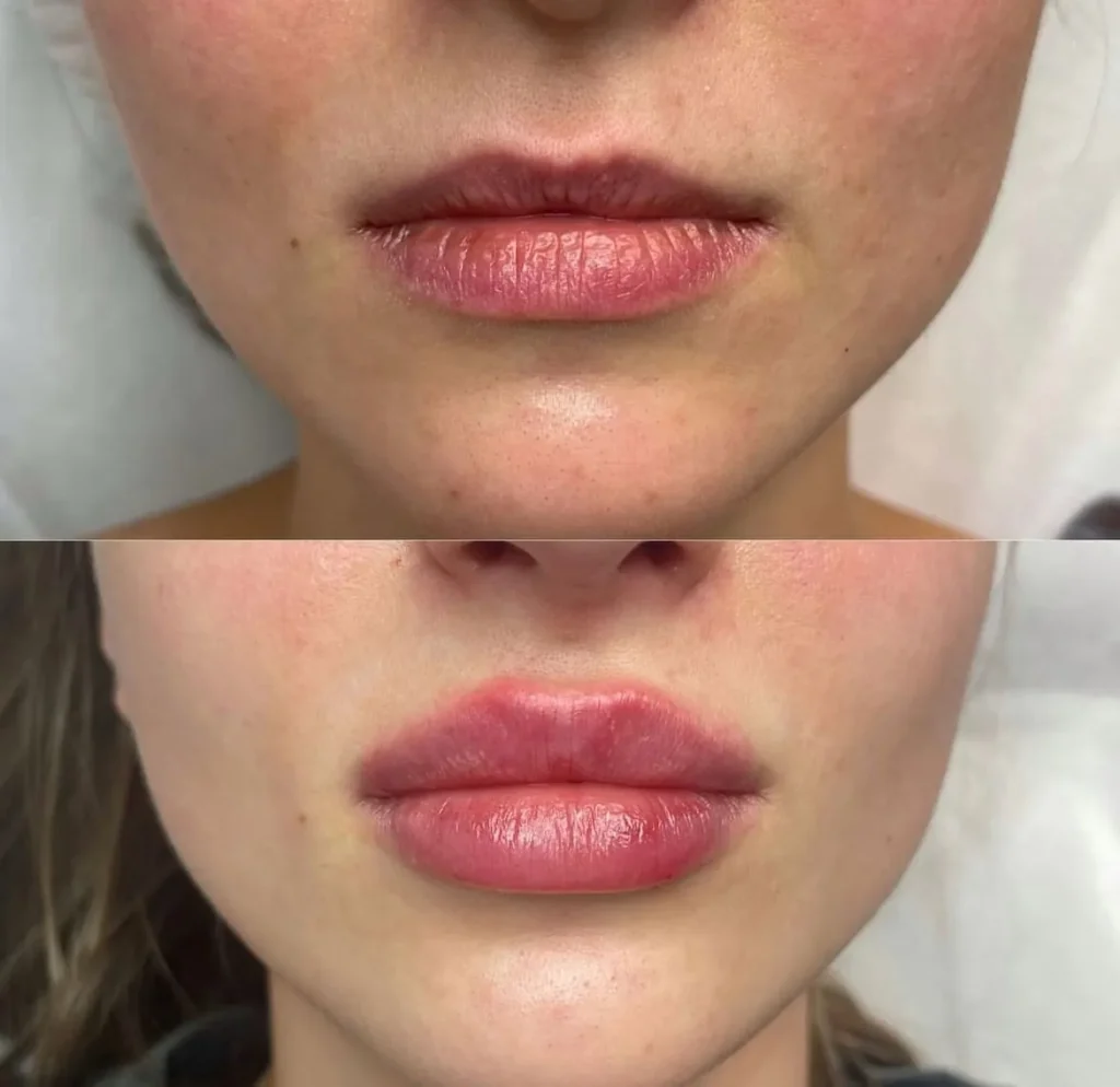 Labios rusos (Russian lips) con ácido hialurónico — caso 3