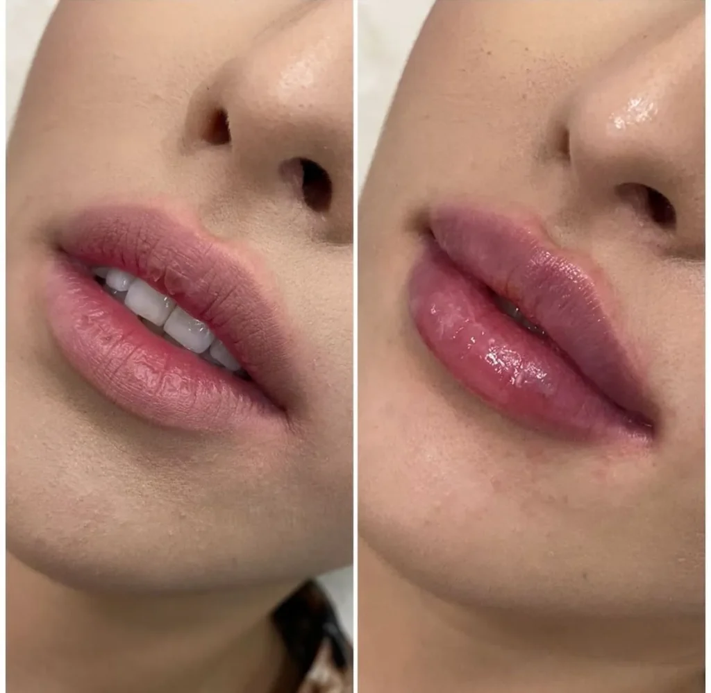 Labios rusos (Russian lips) con ácido hialurónico — caso 4