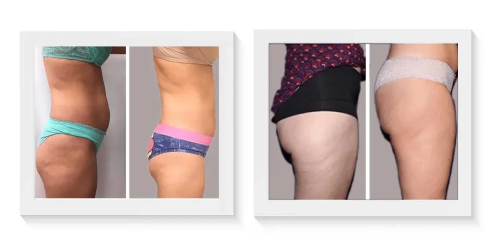 Liposucción antes y después · caso 1
