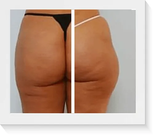 Liposucción de glúteos antes y después