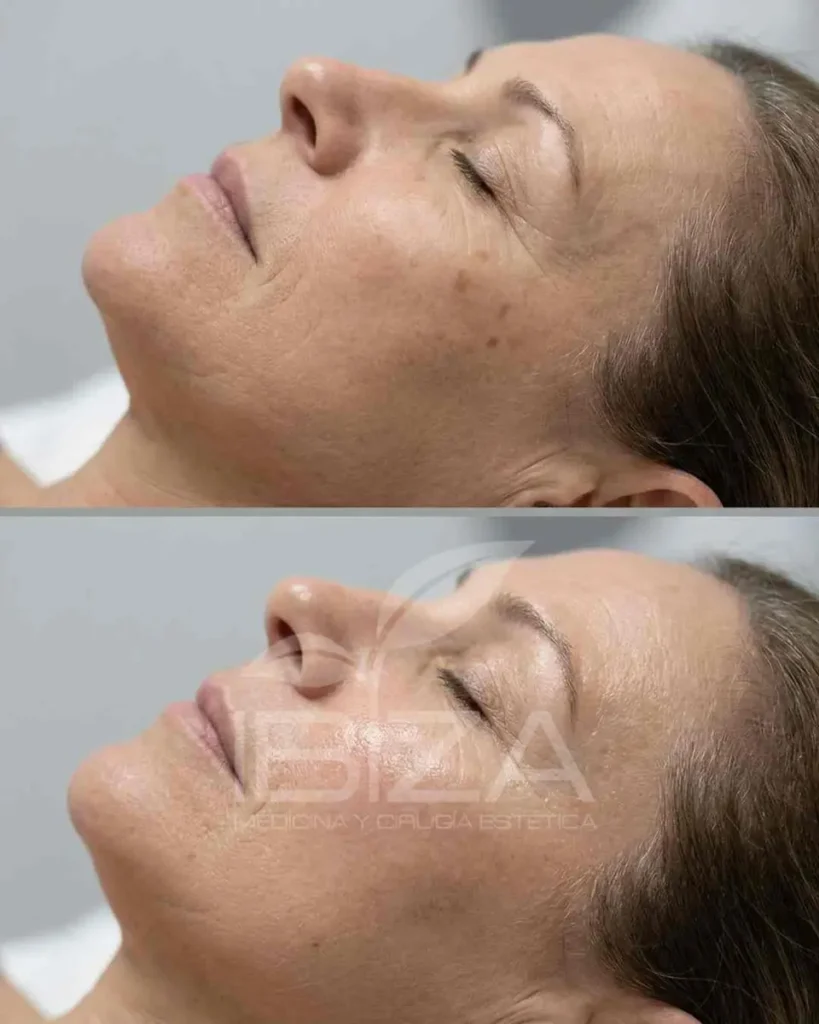 Medicina estética regenerativa antes y después caso 2