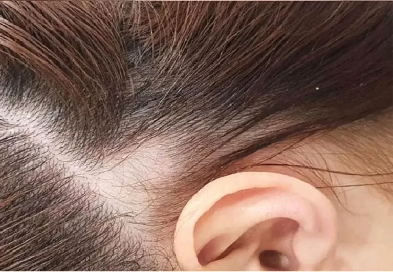 Mesoterapia capilar — Caso 2, antes