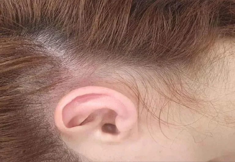 Mesoterapia capilar — Caso 2, despues