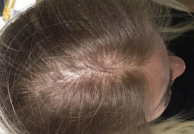 Mesoterapia capilar — Caso 4, antes