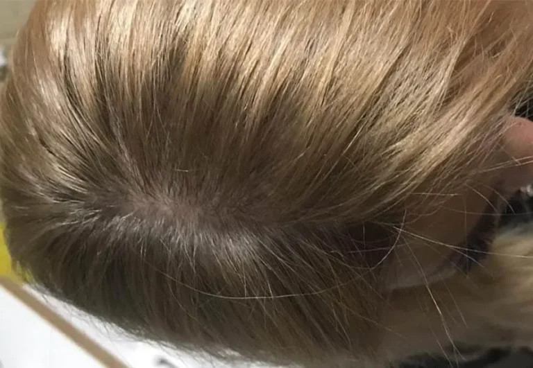 Mesoterapia capilar — Caso 4, despues