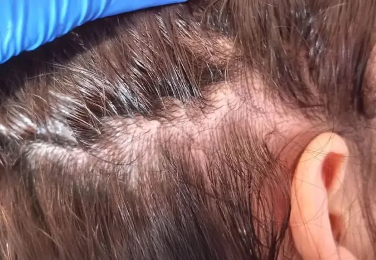 Mesoterapia capilar — Recuperación de cabello, antes