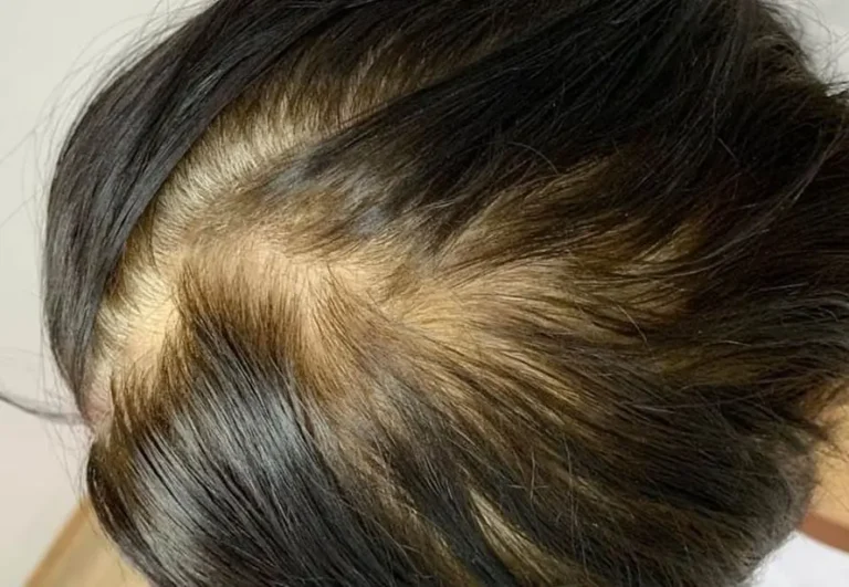 Mesoterapia capilar — Caso 6, antes