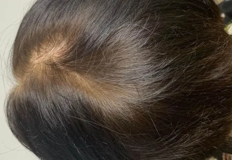 Mesoterapia capilar — Caso 6, despues