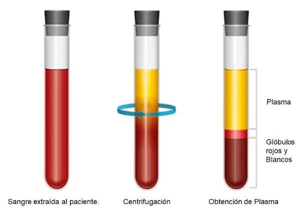 Microinyecciones de PRP capilar en el cuero cabelludo