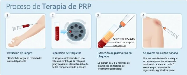 Proceso de bioestimulación plaquetaria · PRP capilar