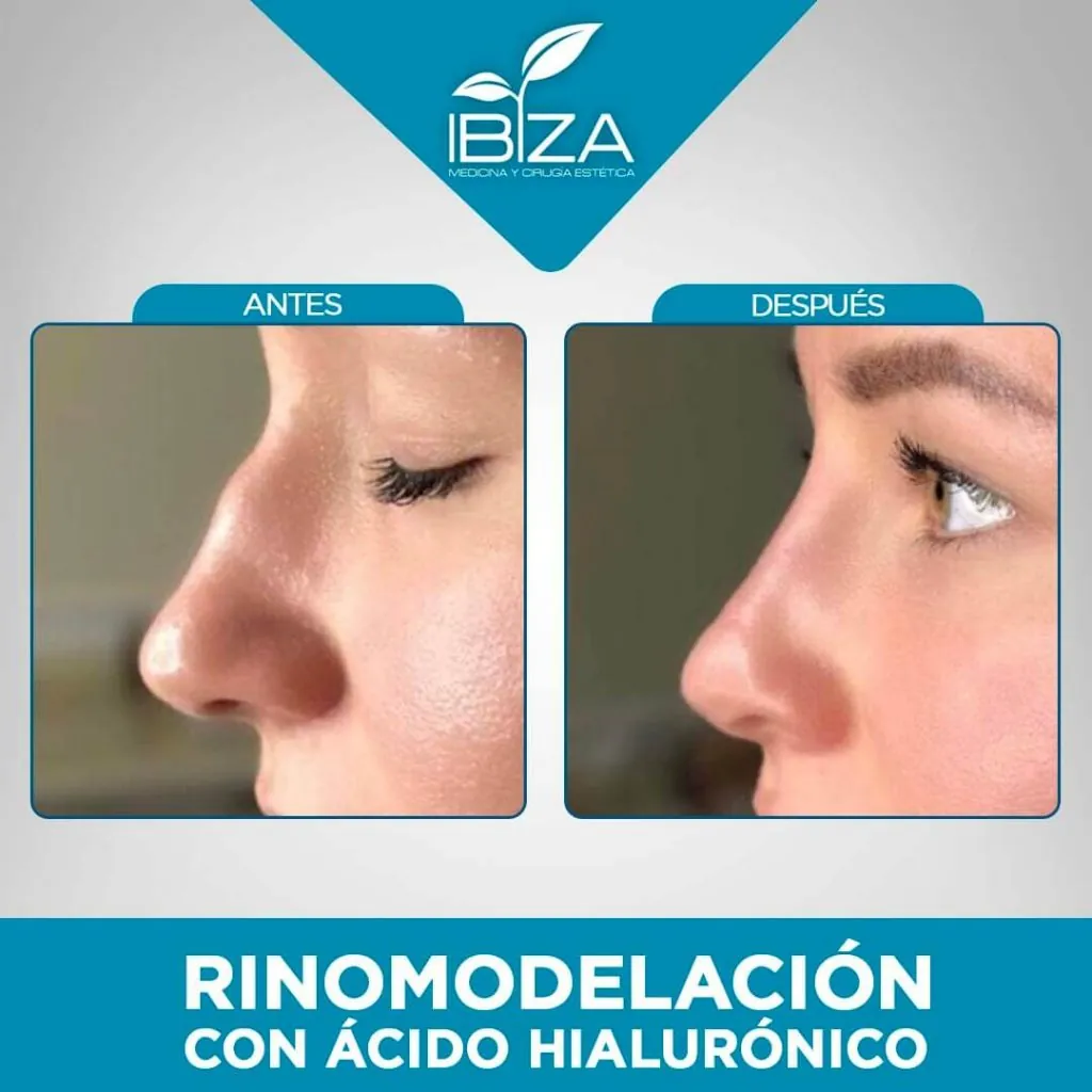 Rinomodelación antes y después, caso representativo