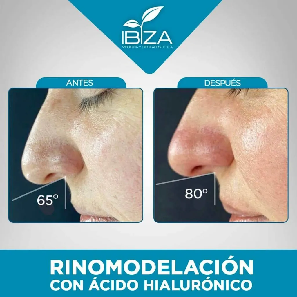 Rinomodelación: elevación de punta nasal antes y después