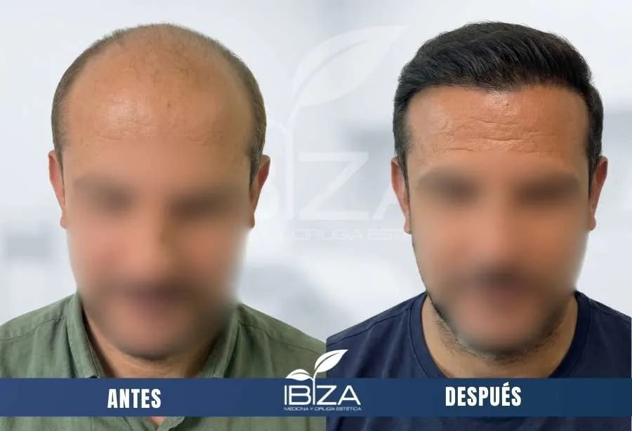 Trasplante capilar comparativa antes-después en hombre de 32 años con 3000 UF, resultado a los 11 meses
