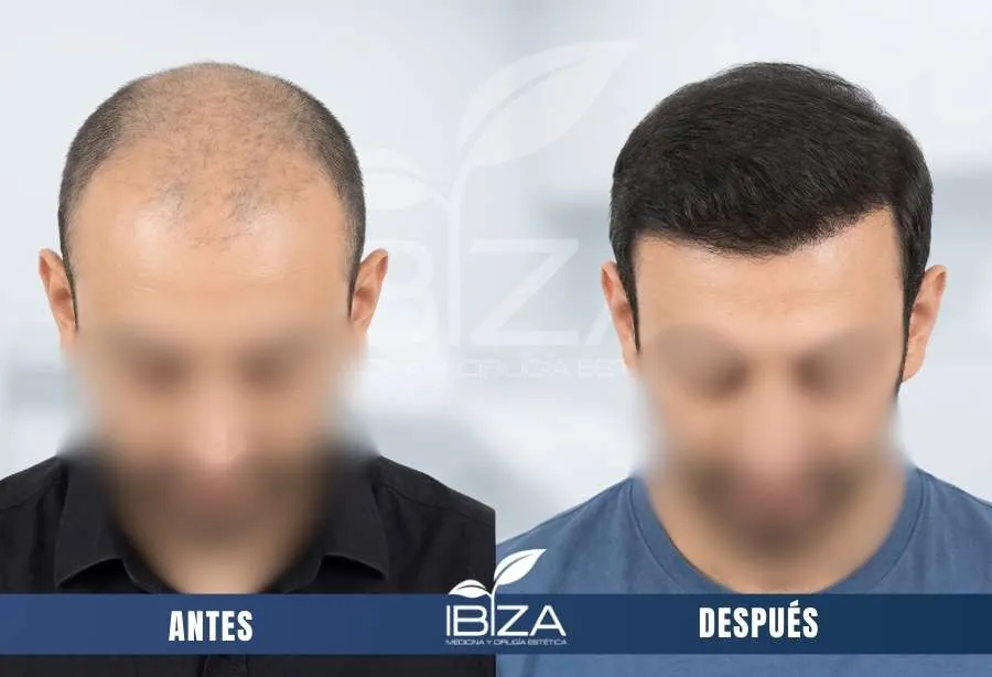 Trasplante capilar transformación antes y después en hombre de 29 años con 3500 UF, resultado a los 12 meses